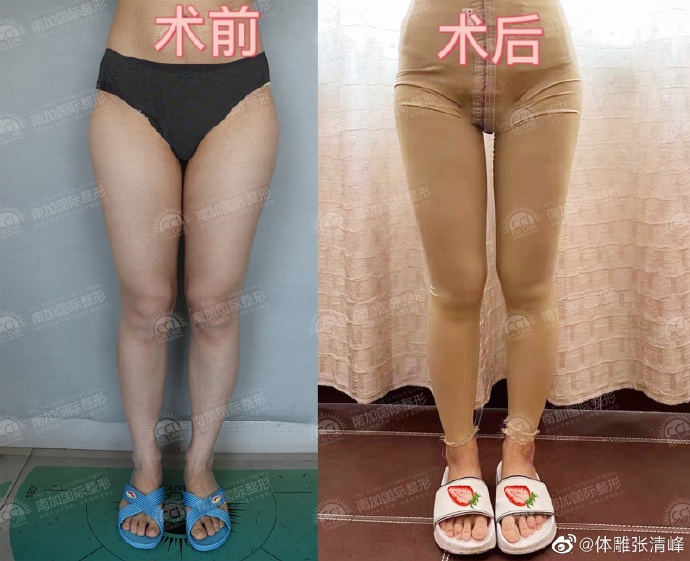 张清峰医生大腿吸脂怎么样